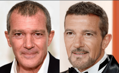 implante-capilar-antonio-banderas