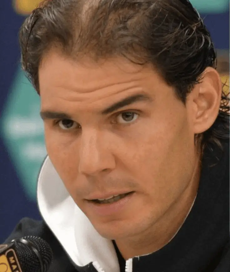 Rafael Nadal antes del implante capilar