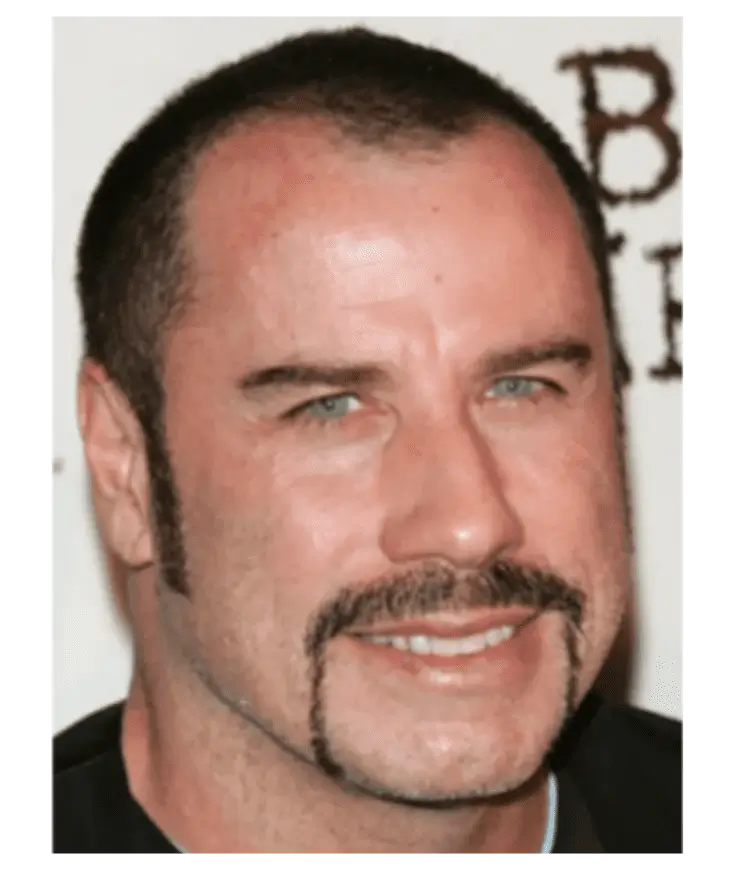 Jhon Travolta antes del implante capilar