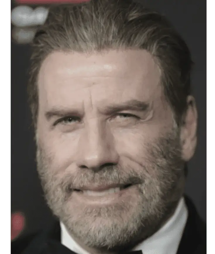 Jhon Travolta después del implante capilar