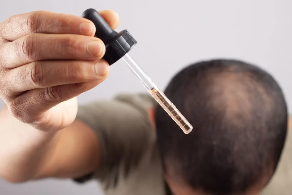 Men Implante Capilar Robótico | minoxidil,minoxidil barba,minoxidil efectos secundarios,minoxidil tópico,minoxidil oral Hombre aplicando minoxidil barba frente al espejo