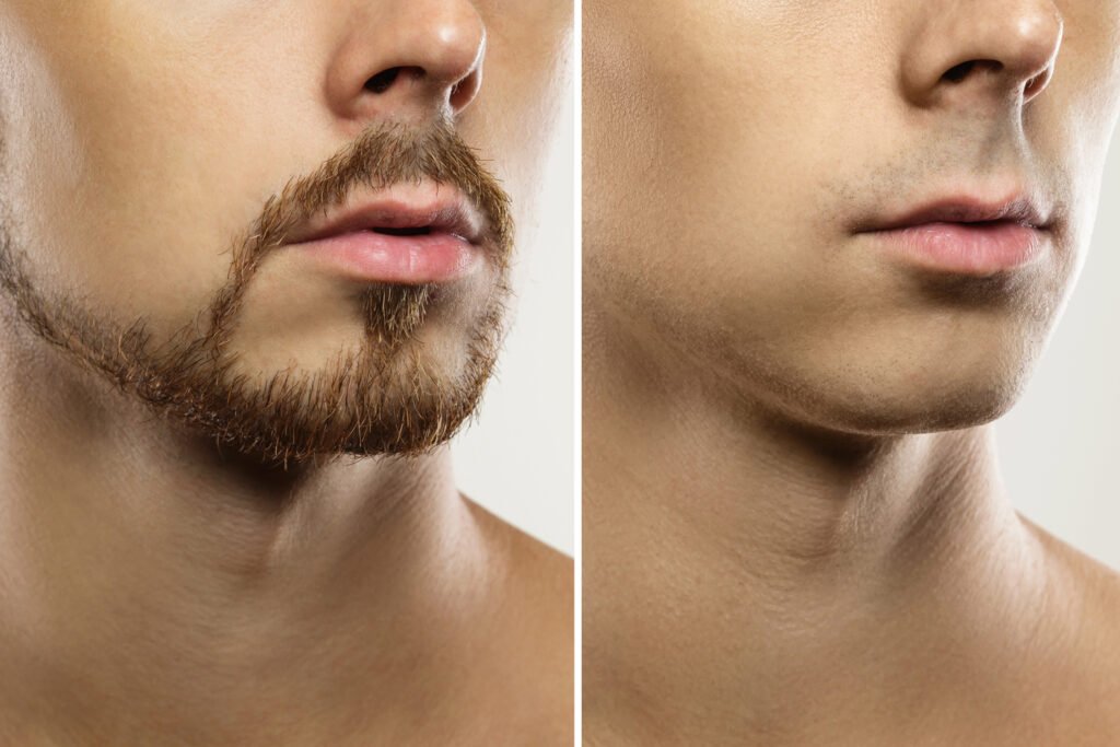 Men Implante Capilar Robótico | implante barba,crecimiento de barba,para estimular el crecimiento de barba,tipos de barba,implante de barba con ARTAS iX™ paciente antes y después de un implante barba- clinica de implante capilar robotica