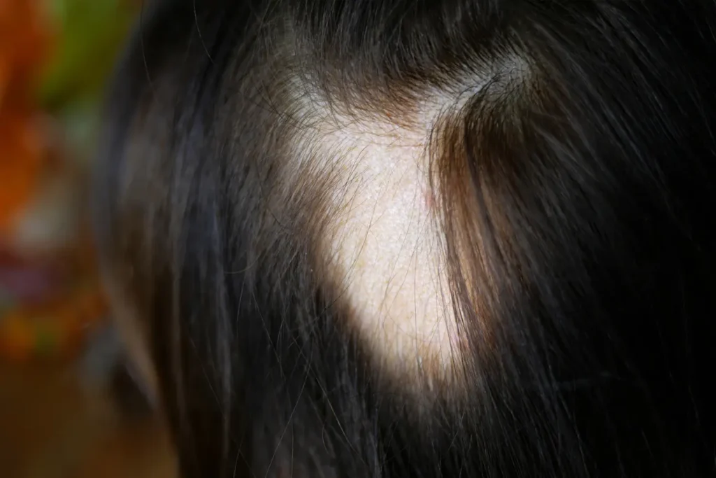 Imagen de cuero cabelludo con parches de alopecia areata