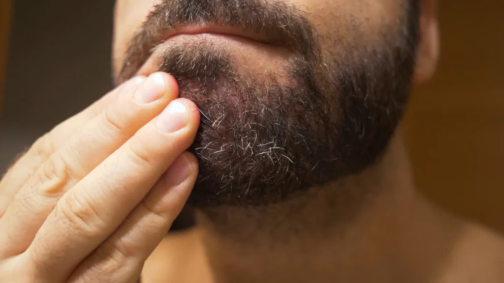 Paciente mostrando síntomas de la alopecia areata en la barba