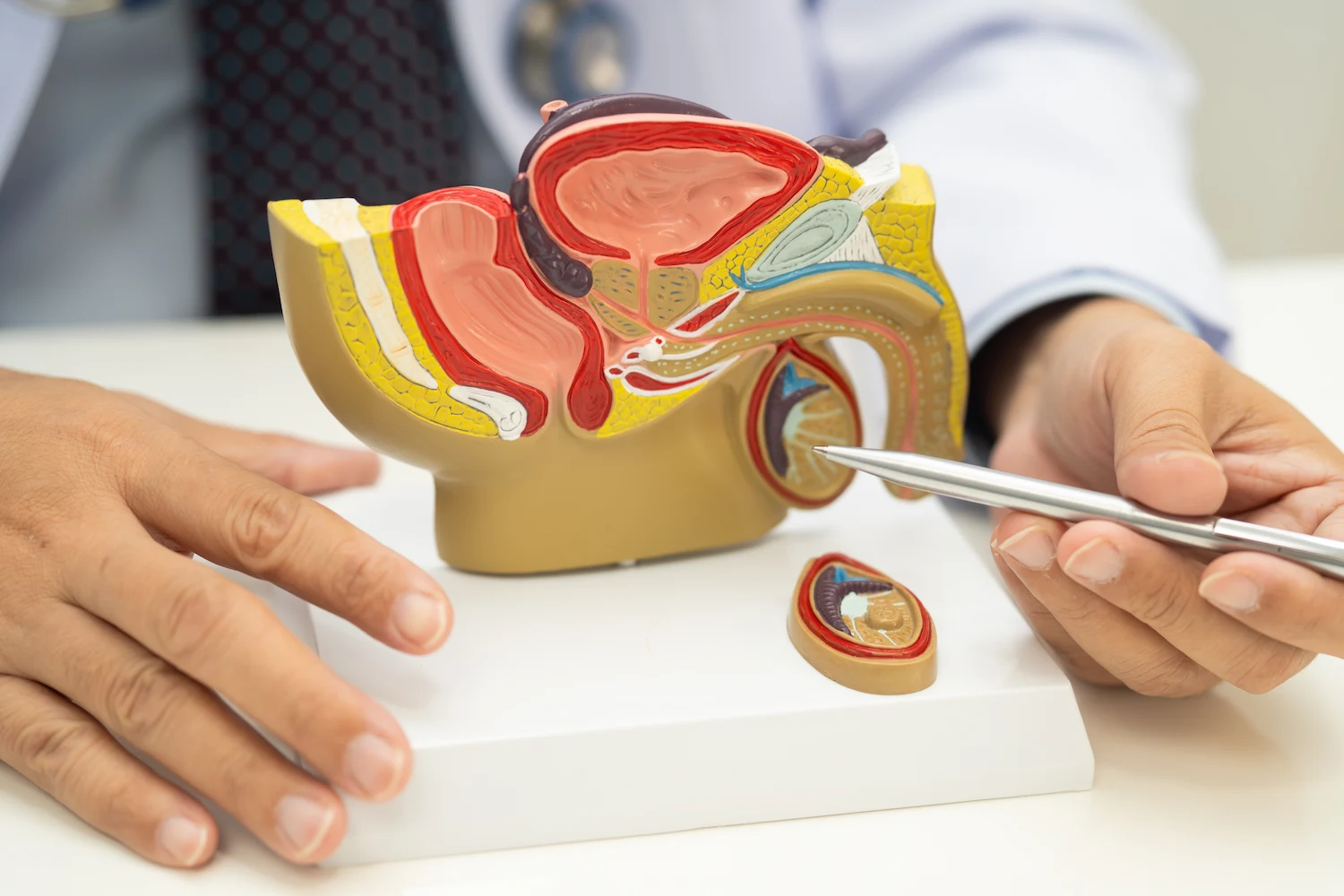 anatomía de la próstata inflamada en un hombre adulto - clínica MEN