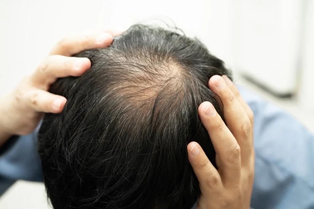 Men Implante Capilar Robótico | caída de cabello por estrés,alopecia por estrés,implante capilar,calvicie,minoxidil Alopecia - clinica del Hombre